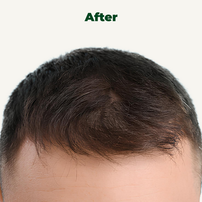 LED Сap for Нair growth restoration