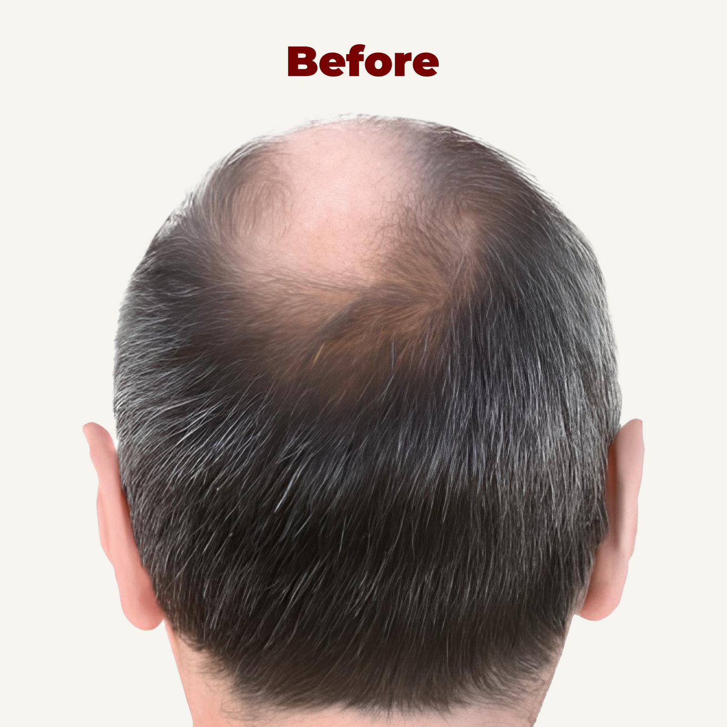 LED Сap for Нair growth restoration